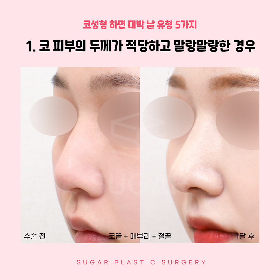 코성형 대박나는 코 관련 이미지 2