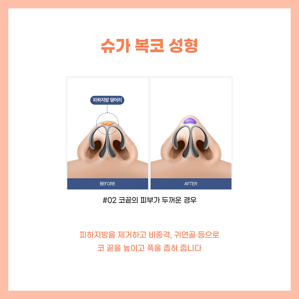 코수술잘하는곳 알아보고 있다면? 관련 이미지 8