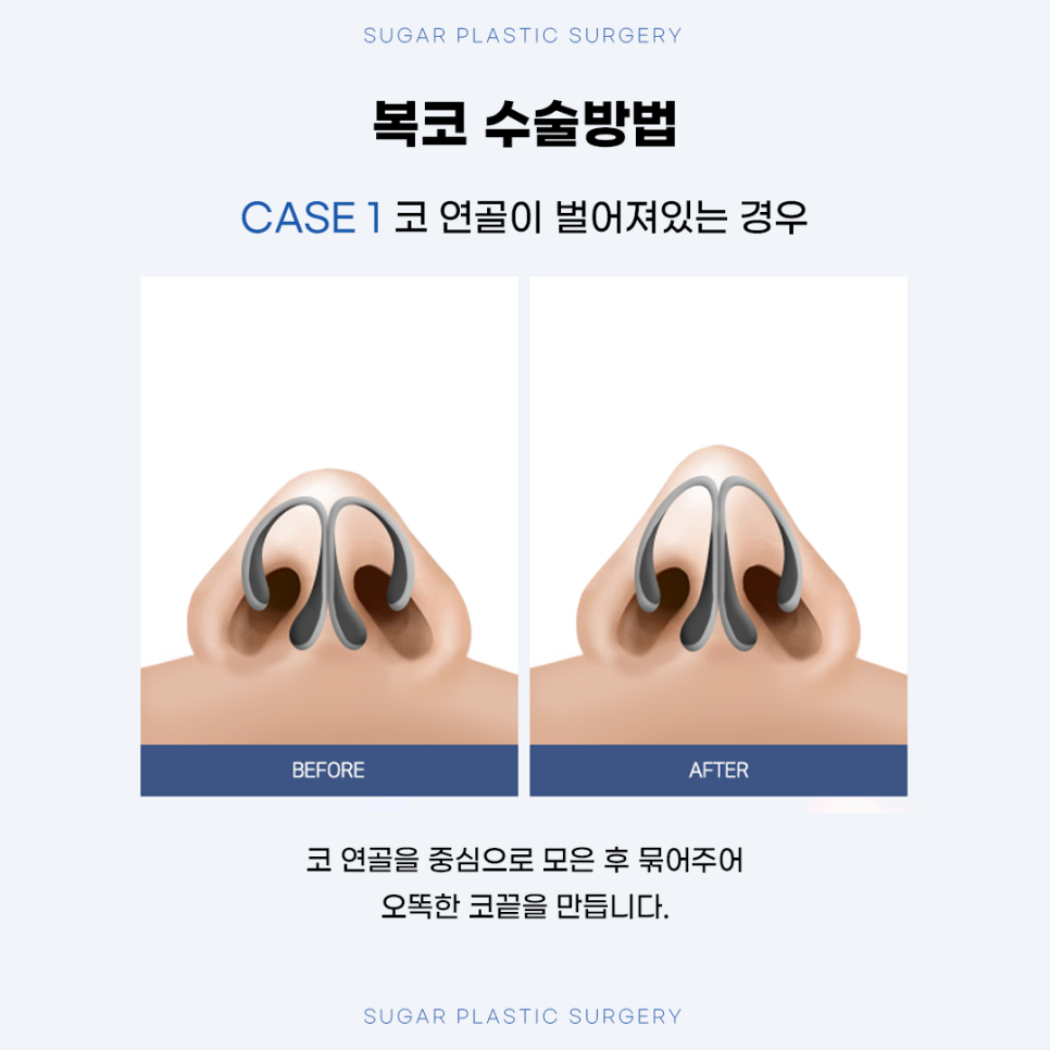 복코성형 원인에 따른 수술방법 관련 이미지 6