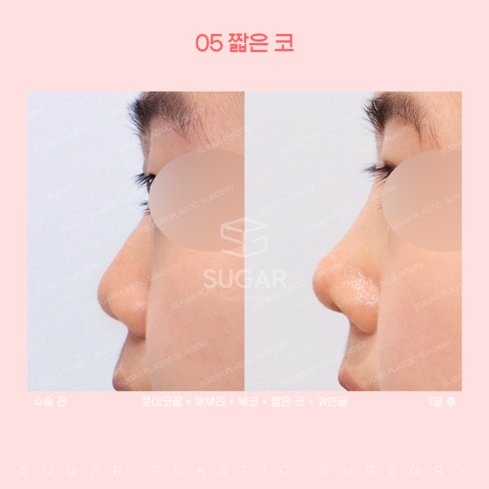 코 유형에 따른 코성형 방법 관련 이미지 18