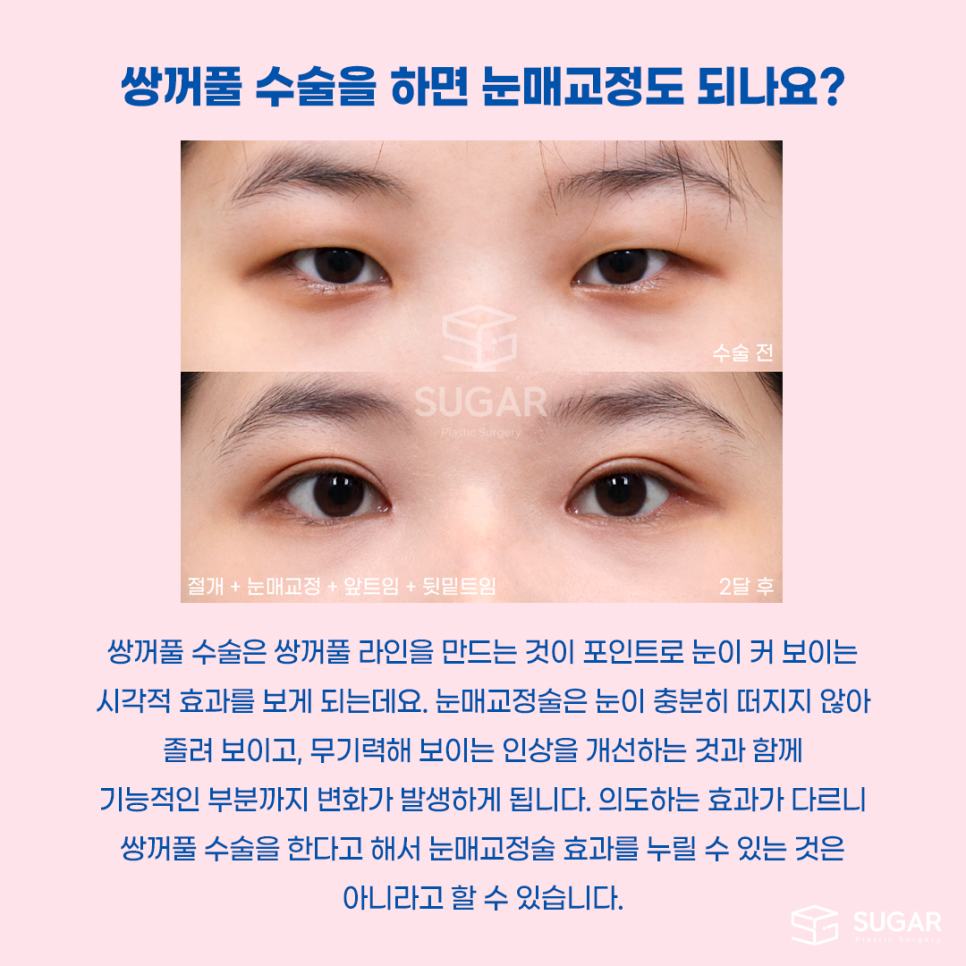 비절개눈매교정 VS 절개눈매교정 관련 이미지 6