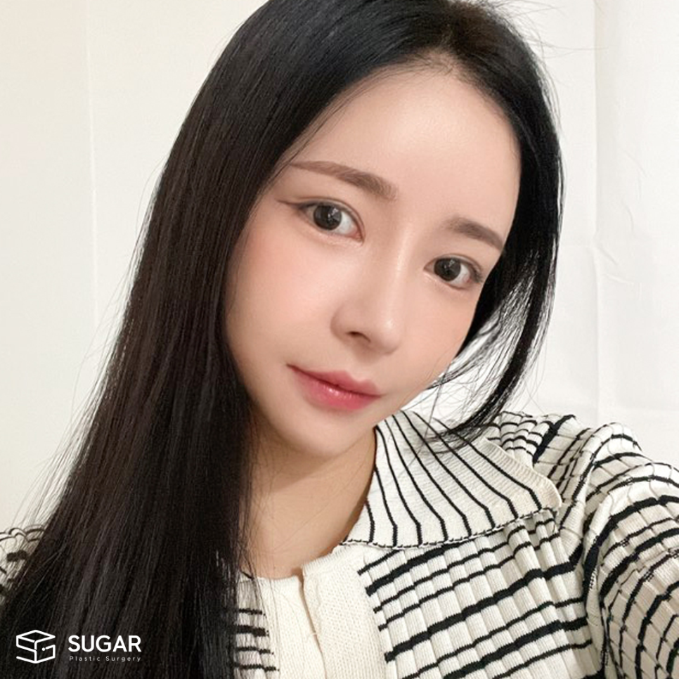 코성형 처음이라면? 용어정리! 관련 이미지 11