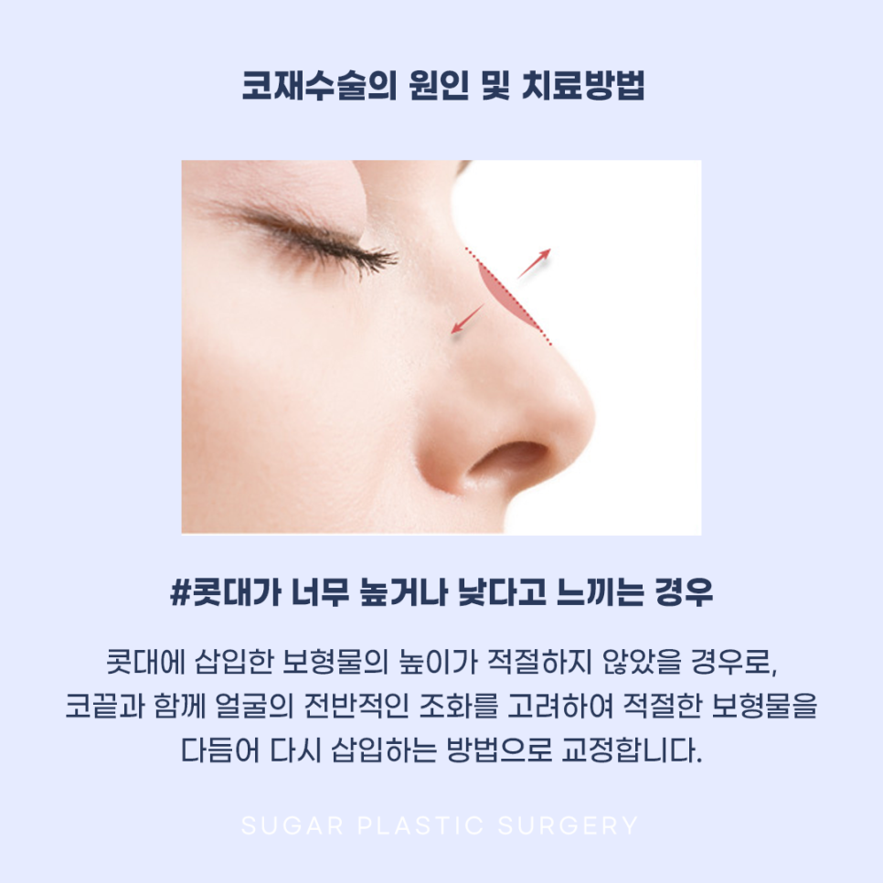 코재수술 그 유형과 해결방법은? 관련 이미지 6
