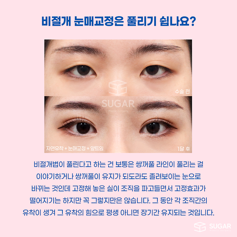 비절개눈매교정 VS 절개눈매교정 관련 이미지 10
