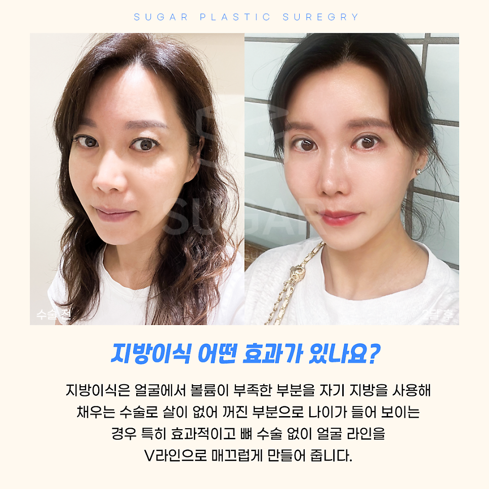 지방이식 vs 필러 어떤게 좋을까 관련 이미지 2