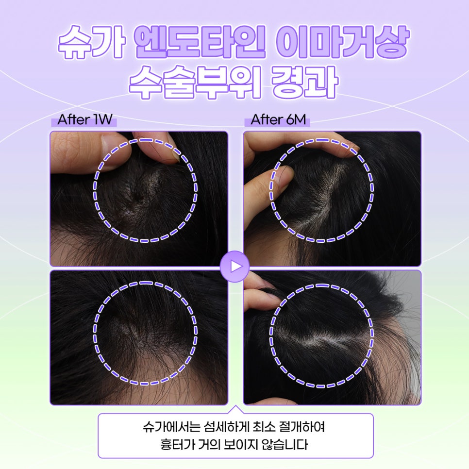 강남역이마거상수술 엔도타인으로 고정점을 확실히 관련 이미지 10