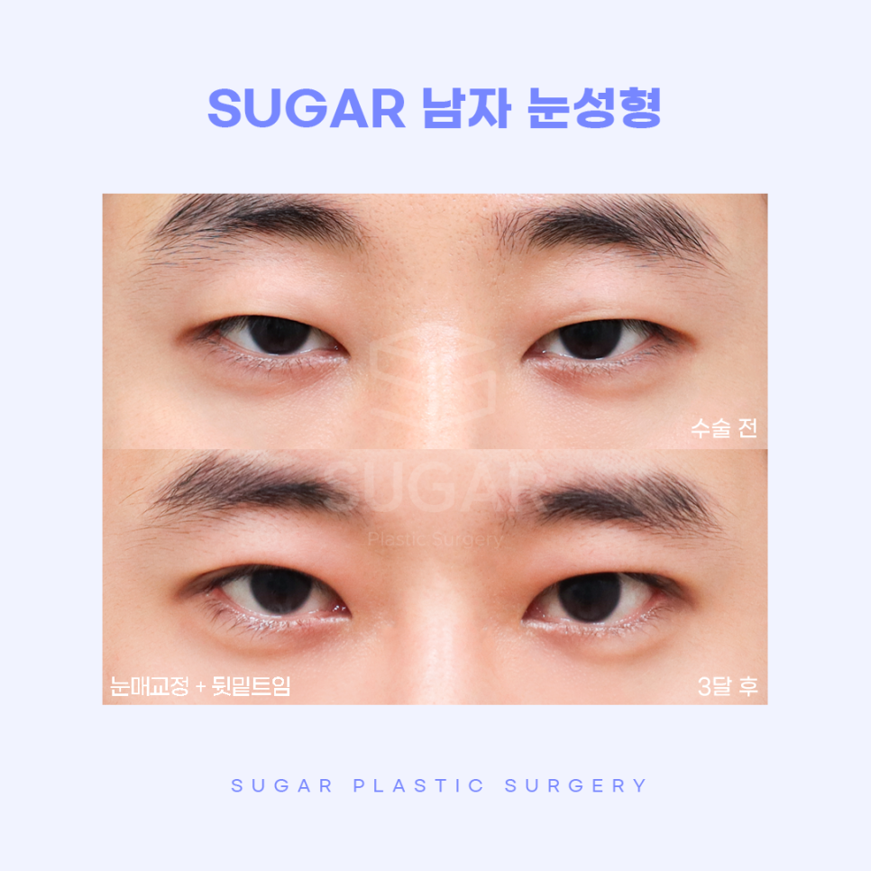 남자성형 대박나는 조건 관련 이미지 8