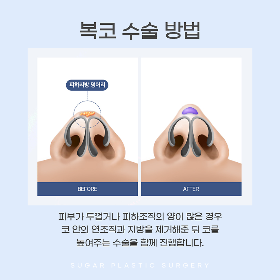 콧볼축소와 코끝성형을 같이 하는 이유는? 관련 이미지 9