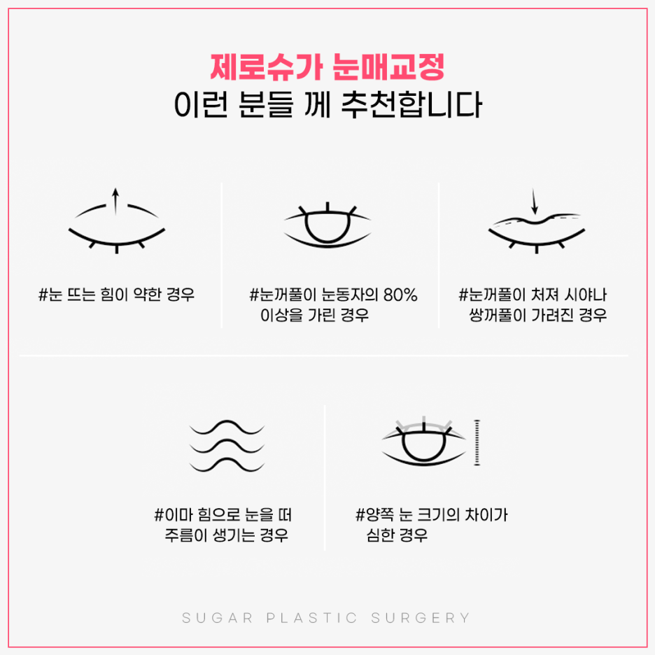 눈매교정 꼭 해야할까? 관련 이미지 6