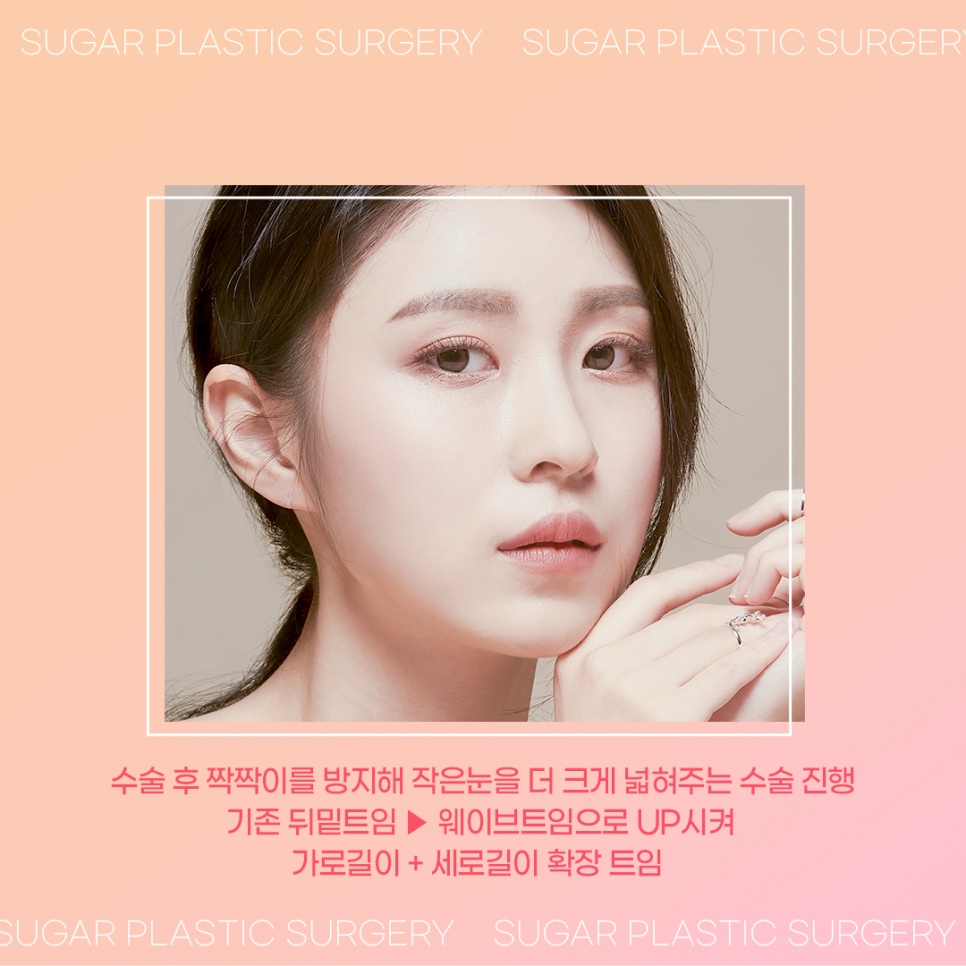 강남눈성형 뒤밑트임잘하는곳 2포인트로 확실하게 관련 이미지 5