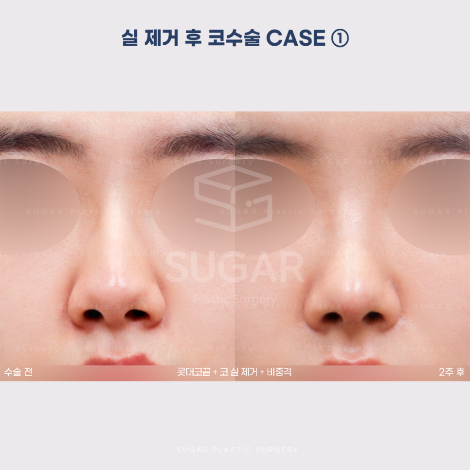 [슈가성형외과] 이런 코시술 하지마세요 관련 이미지 5