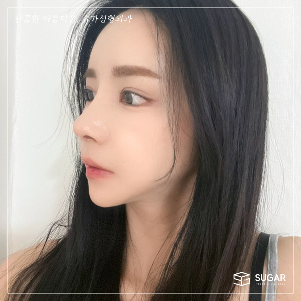 코재수술 마지막이 되려면 관련 이미지 5