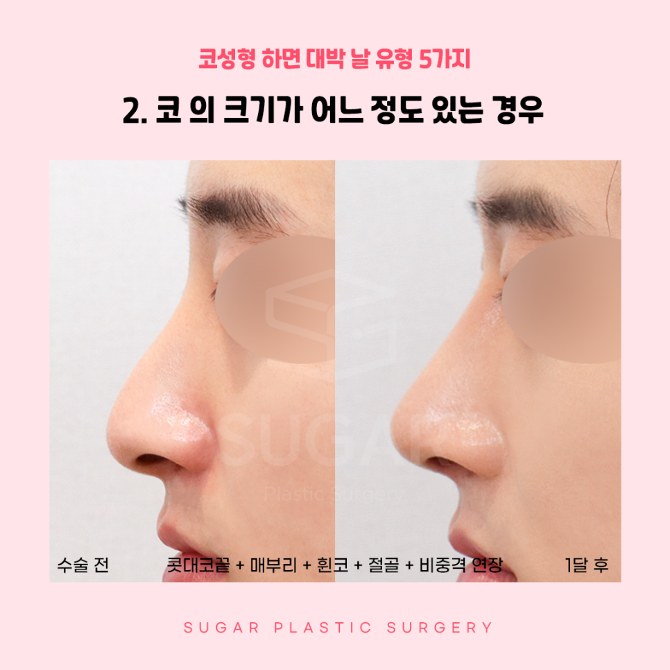 코성형 대박나는 코 관련 이미지 5