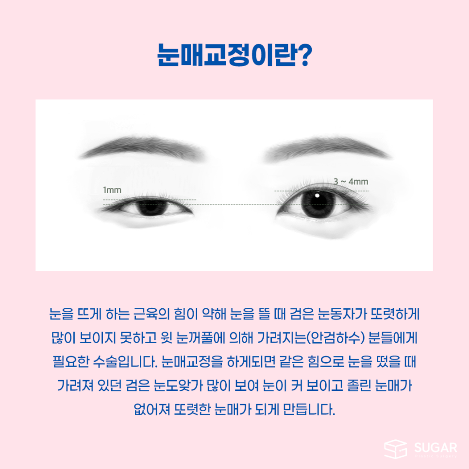 비절개눈매교정 VS 절개눈매교정 관련 이미지 2