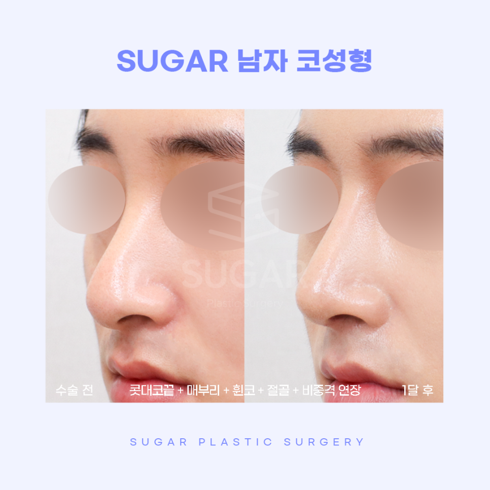 남자성형 대박나는 조건 관련 이미지 11