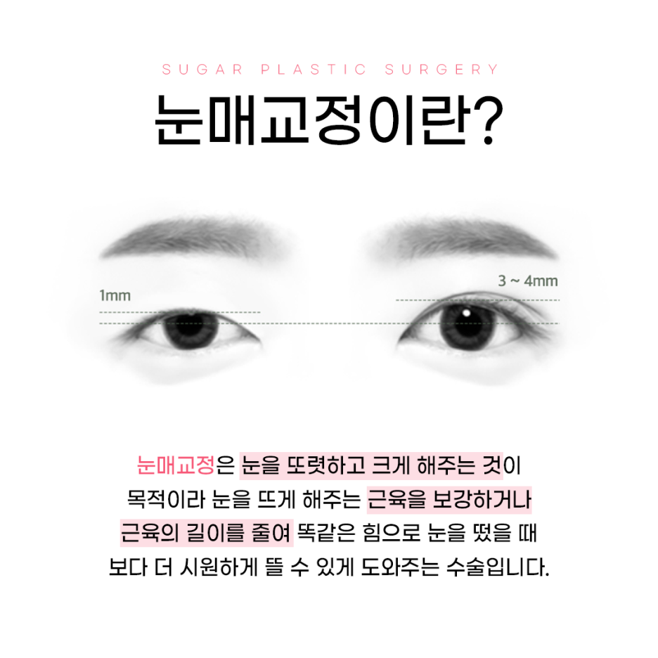 쌍꺼풀과 눈매교정의 차이점 관련 이미지 2