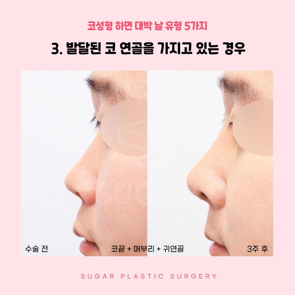코성형 대박나는 코 관련 이미지 7