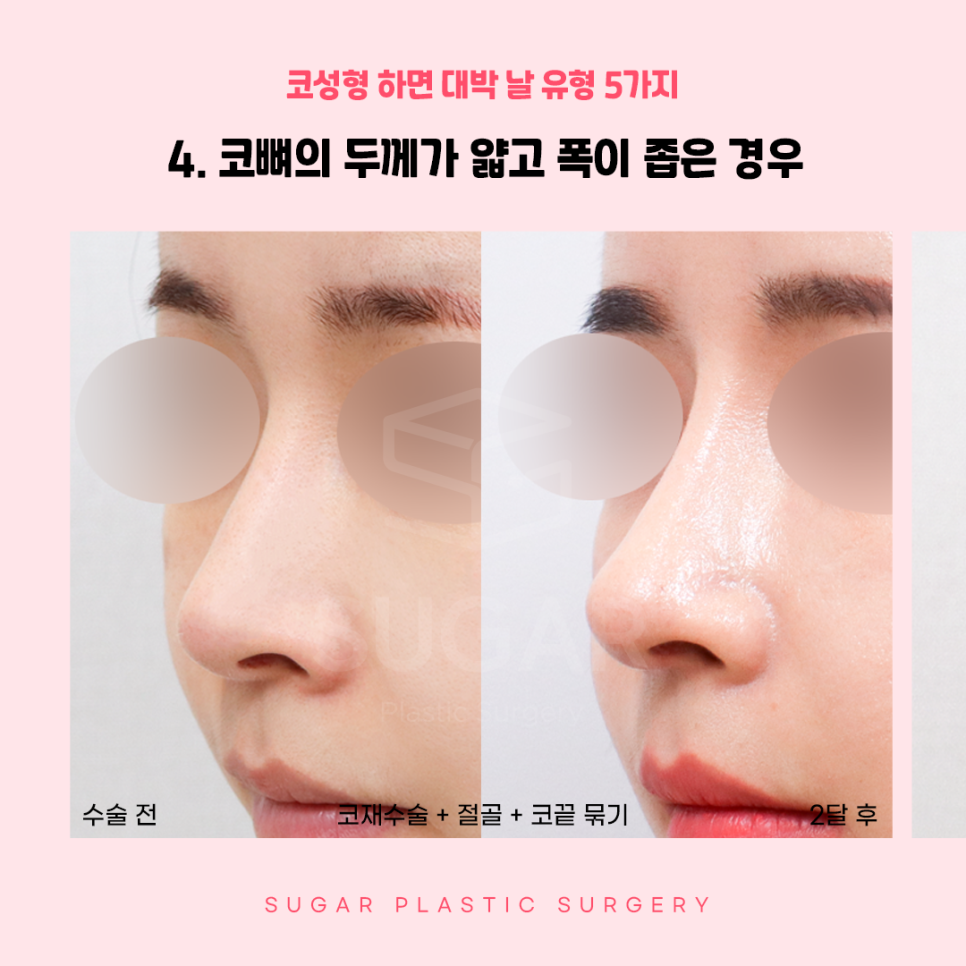 코성형 대박나는 코 관련 이미지 8