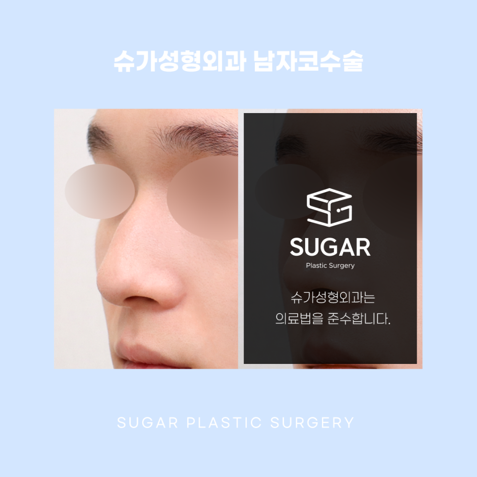 남자코수술 여자랑 어떻게 다를까 관련 이미지 4