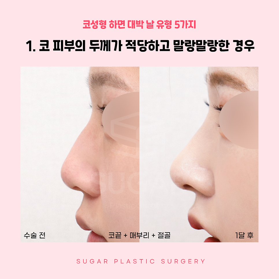 코성형 대박나는 코 관련 이미지 3