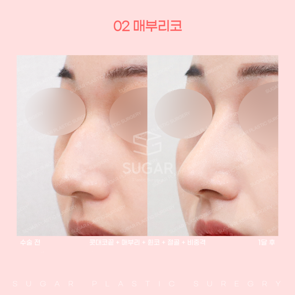 코 유형에 따른 코성형 방법 관련 이미지 8
