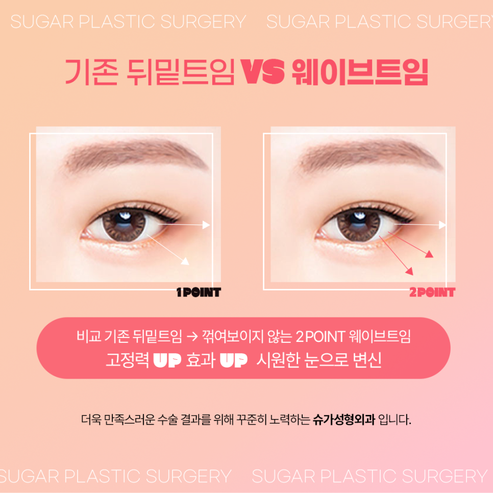 강남눈성형 뒤밑트임잘하는곳 2포인트로 확실하게 관련 이미지 4