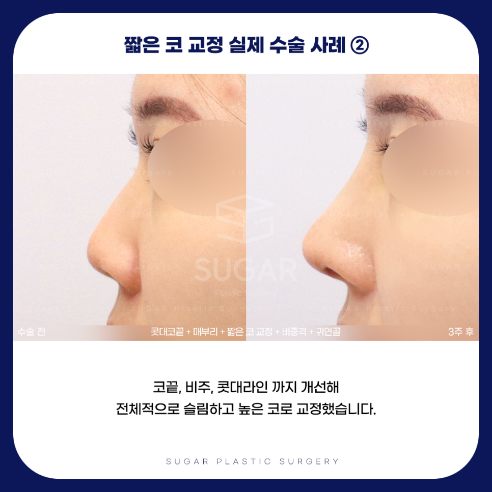긴코 VS 짧은코 관련 이미지 17