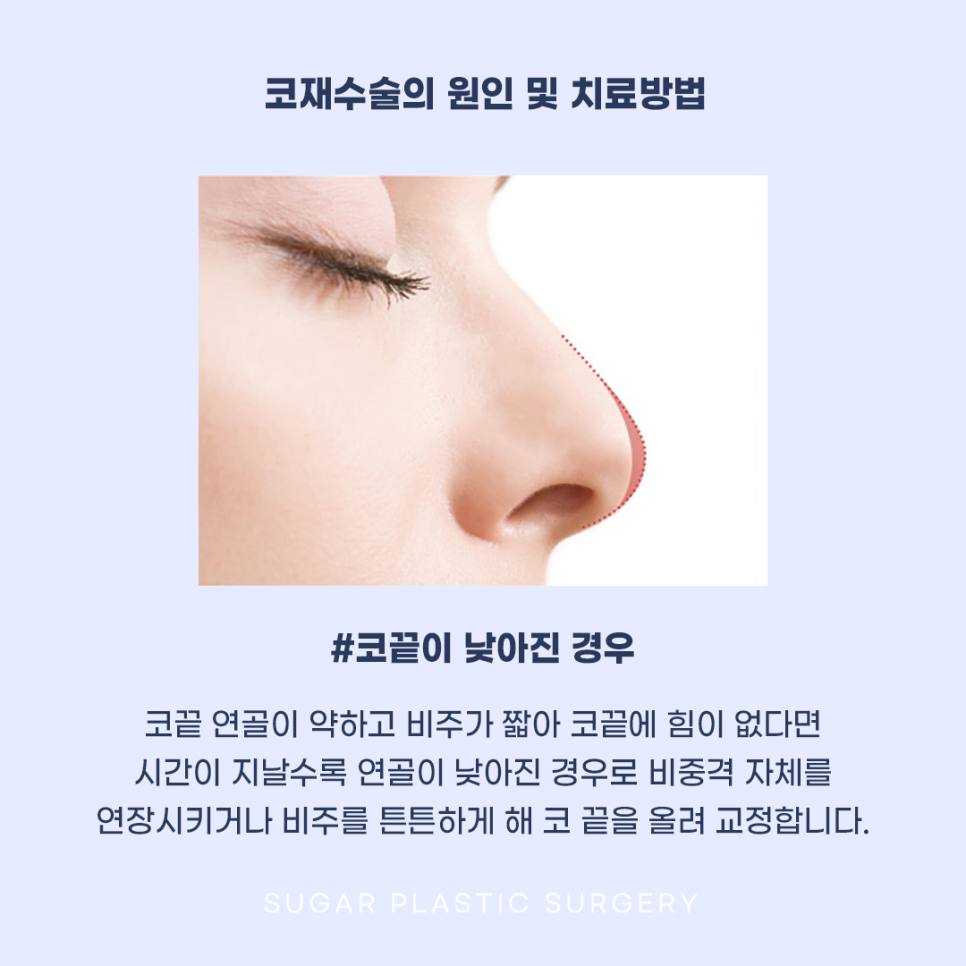 코재수술 그 유형과 해결방법은? 관련 이미지 4