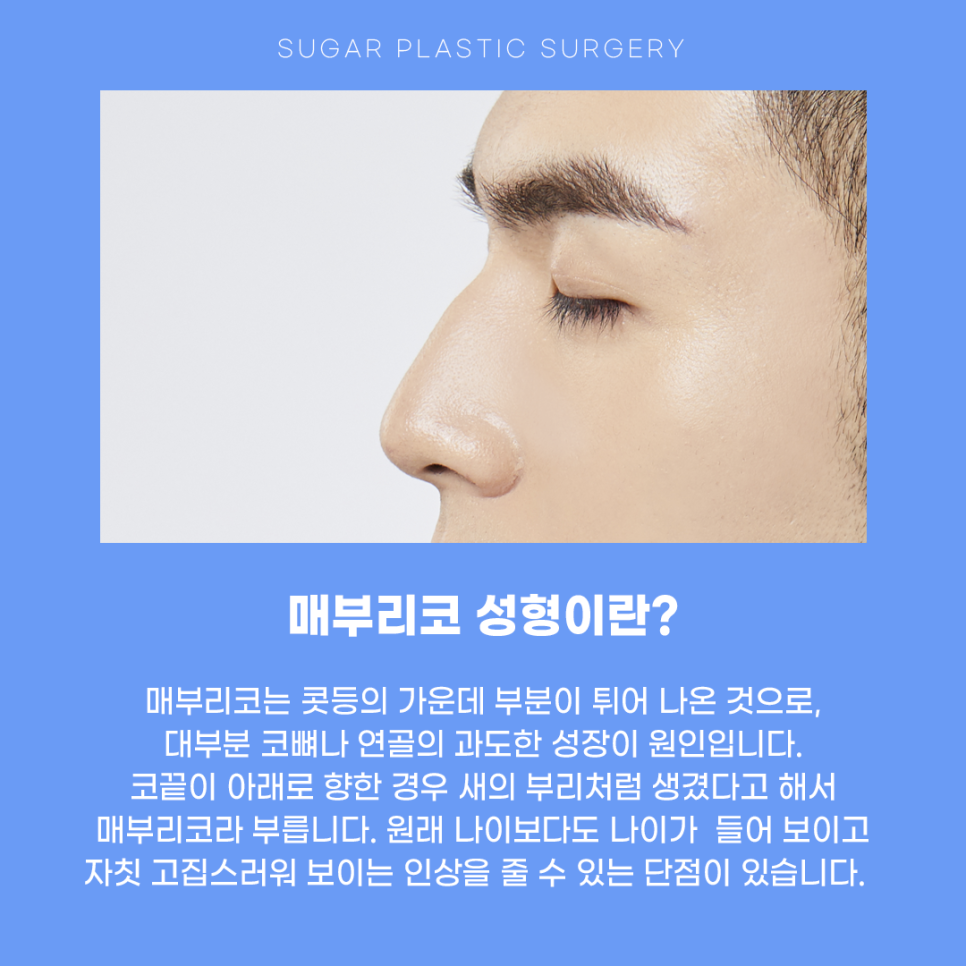 매부리코수술 매끄러운 라인으로 관련 이미지 2