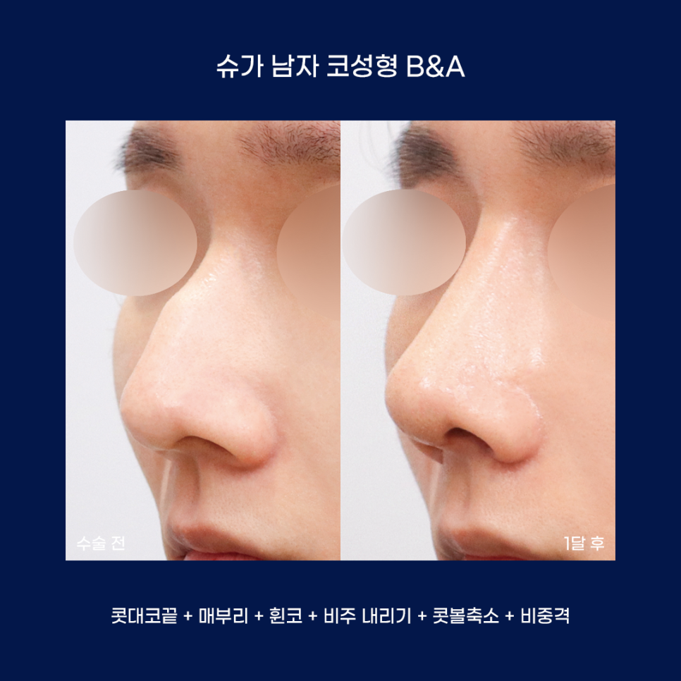 남자성형에 관한 궁금한 점 다 알려드립니다! 관련 이미지 14