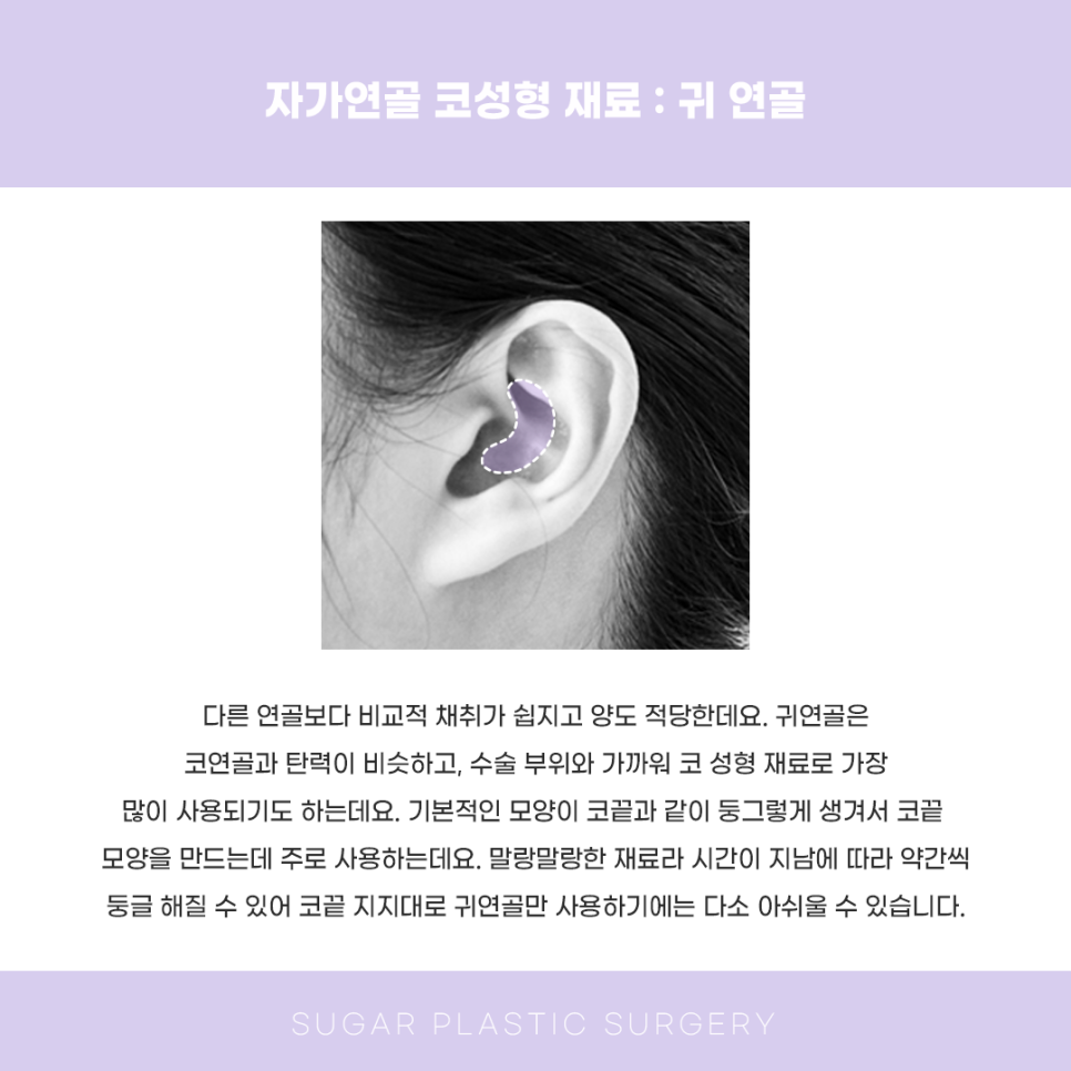 코성형 재료 다 알려드림 관련 이미지 4