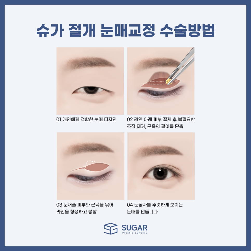 남자눈성형 뭐가 다를까? 관련 이미지 7