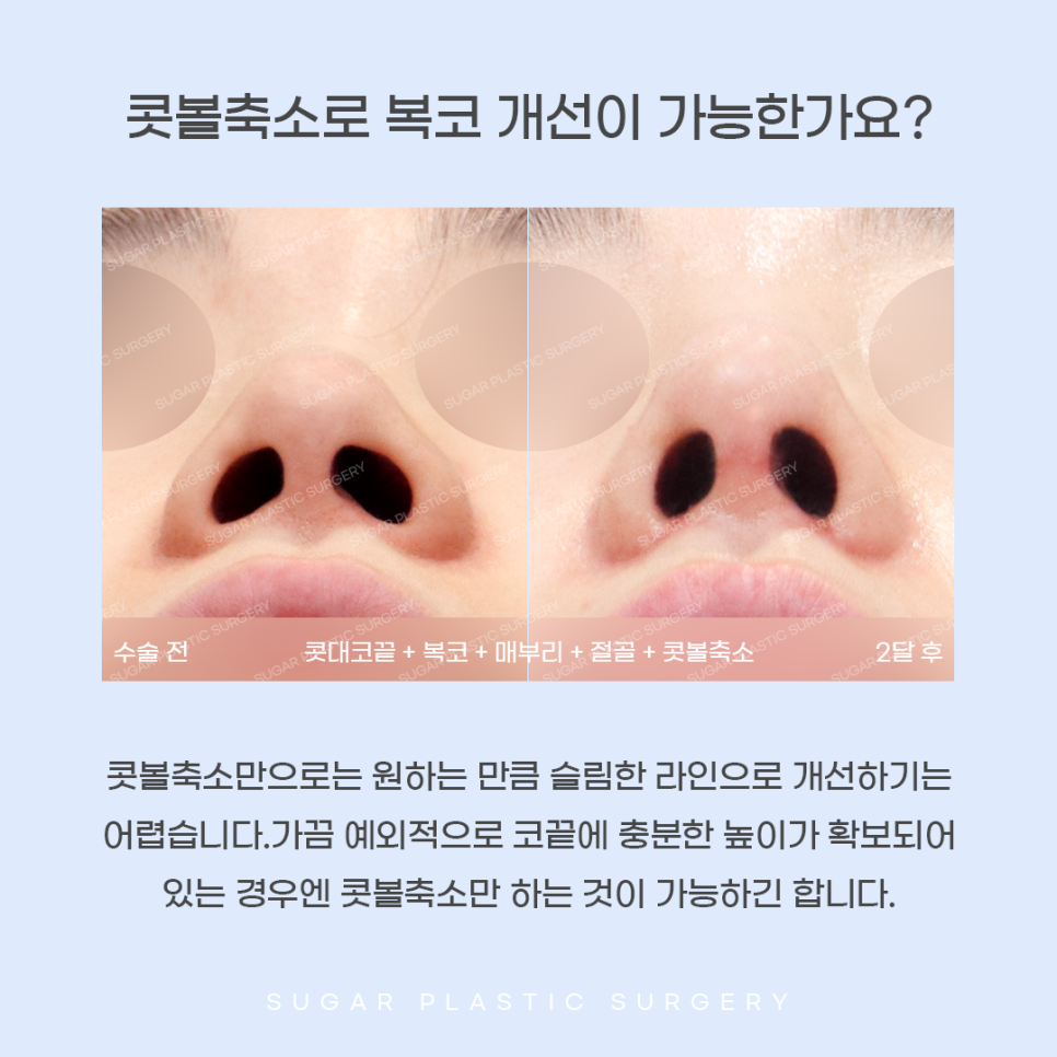 콧볼축소와 코끝성형을 같이 하는 이유는? 관련 이미지 4