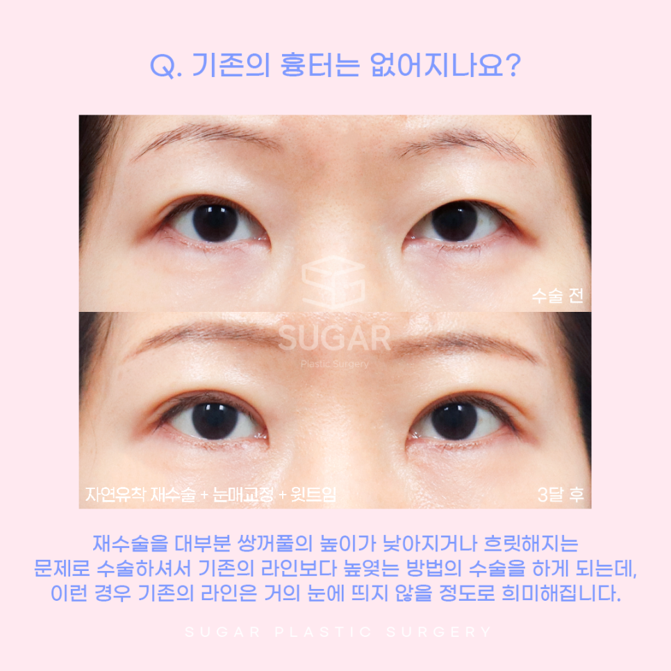 눈재수술 비절개로 가능할까? 관련 이미지 9