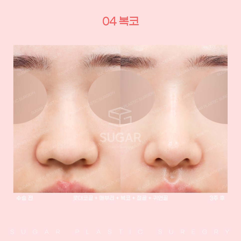 코 유형에 따른 코성형 방법 관련 이미지 14
