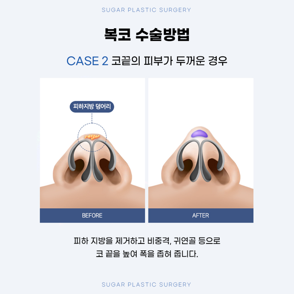 복코성형 원인에 따른 수술방법 관련 이미지 7
