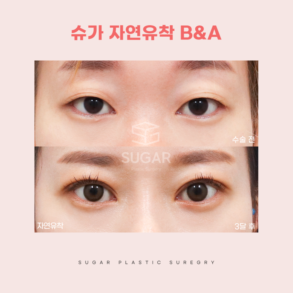 연예인쌍수라인으로 보는 쌍꺼풀라인 관련 이미지 12