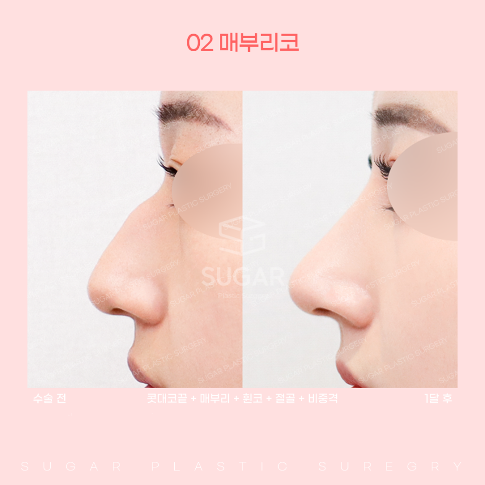 코 유형에 따른 코성형 방법 관련 이미지 9