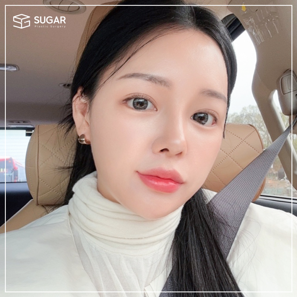 [슈가성형외과] 눈성형 실패하는 이유! 관련 이미지 12