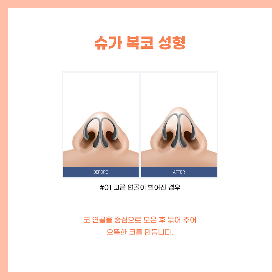코수술잘하는곳 알아보고 있다면? 관련 이미지 7