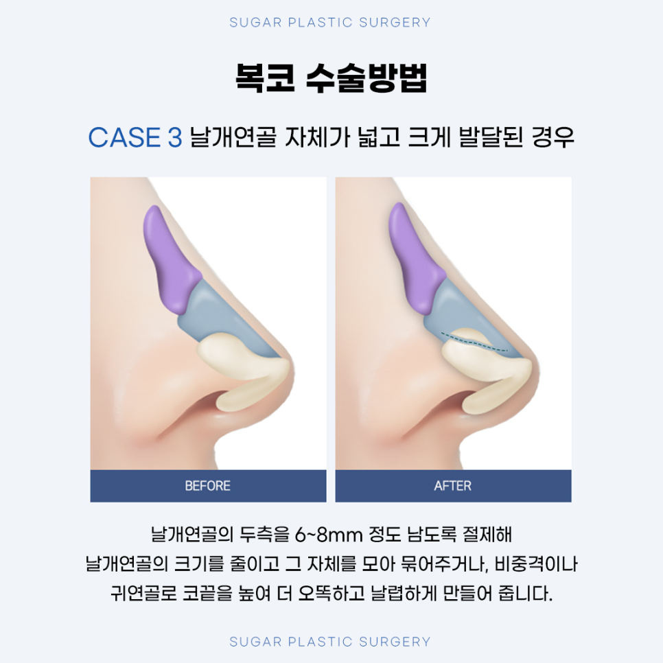 복코성형 원인에 따른 수술방법 관련 이미지 8