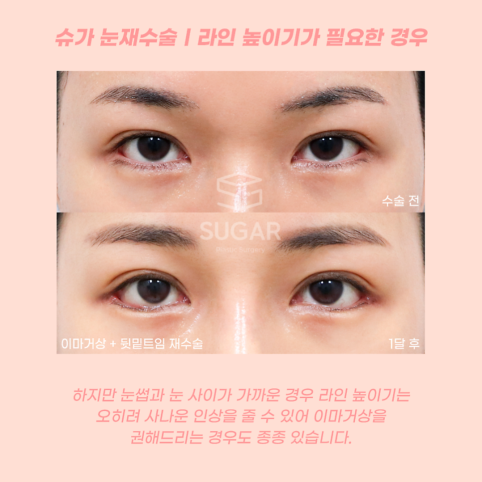 눈재수술 라인높이는 방법 관련 이미지 3