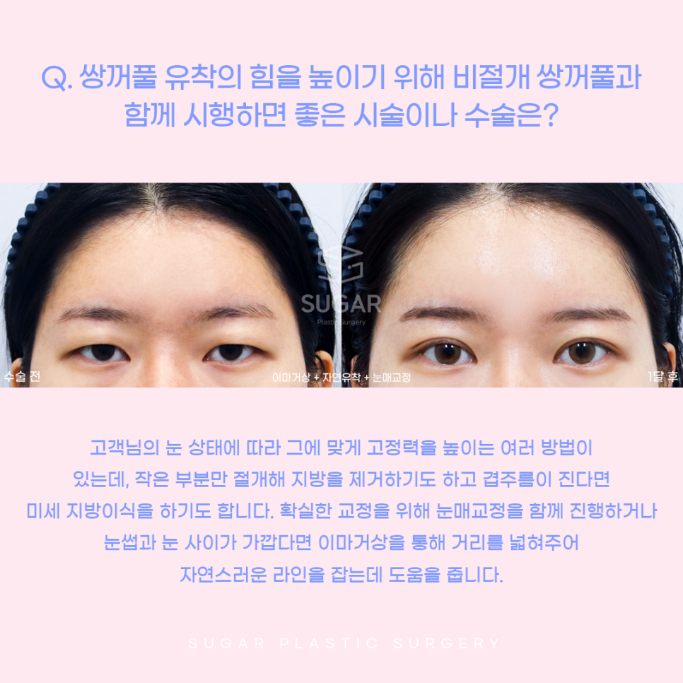 눈재수술 비절개로 가능할까? 관련 이미지 8