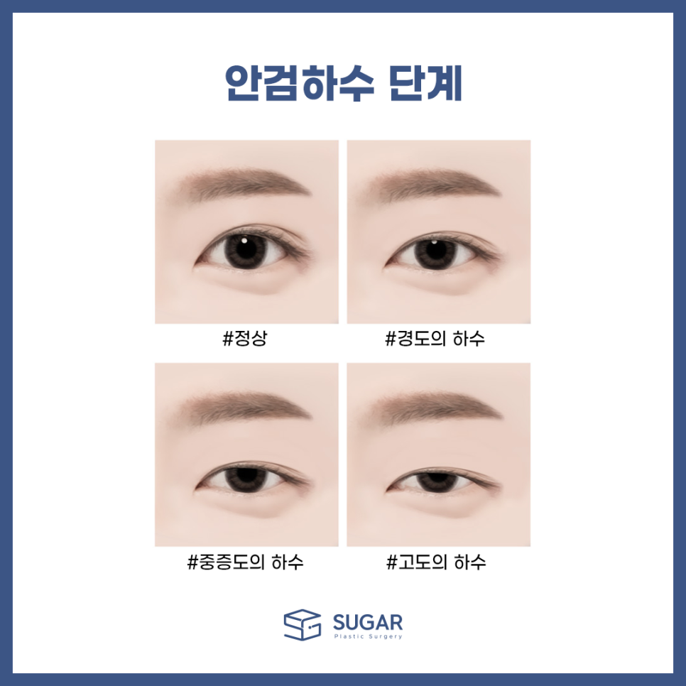남자눈성형 뭐가 다를까? 관련 이미지 5
