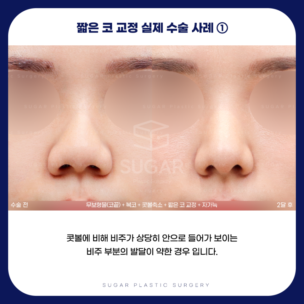 긴코 VS 짧은코 관련 이미지 12