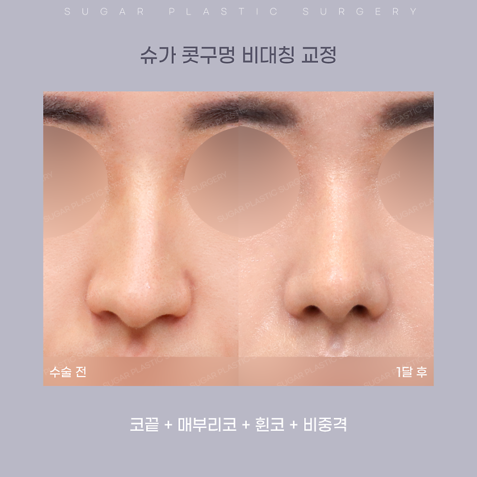 코 성형 후 콧구멍 짝짝이가 되었다?! 관련 이미지 8