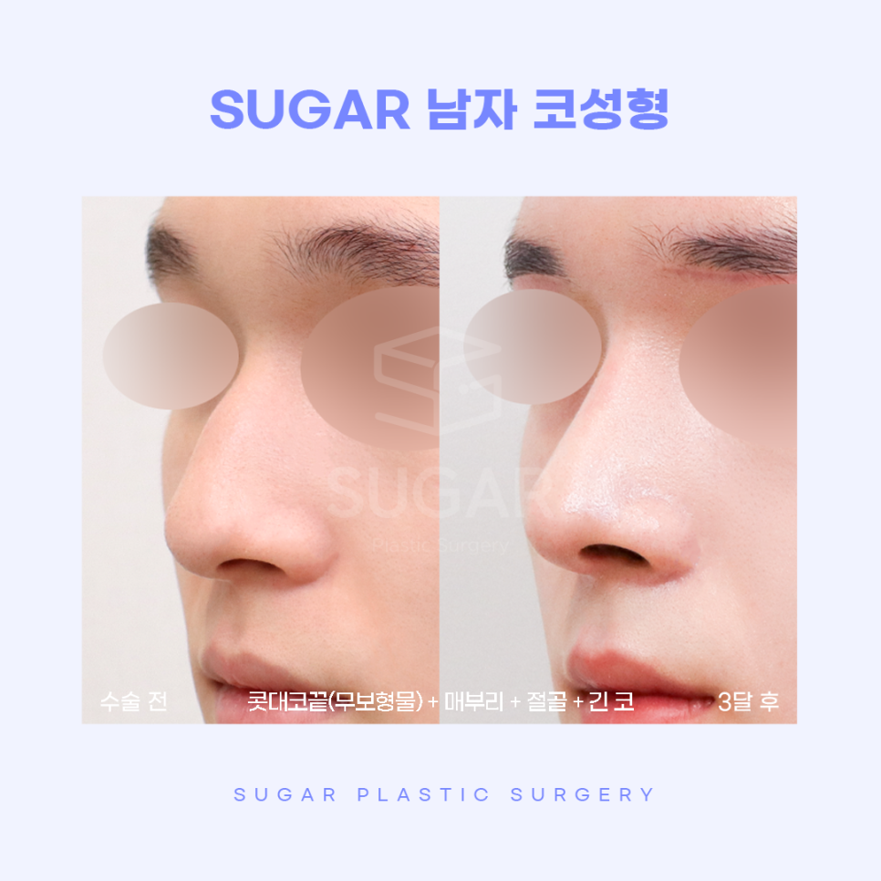 남자성형 대박나는 조건 관련 이미지 10