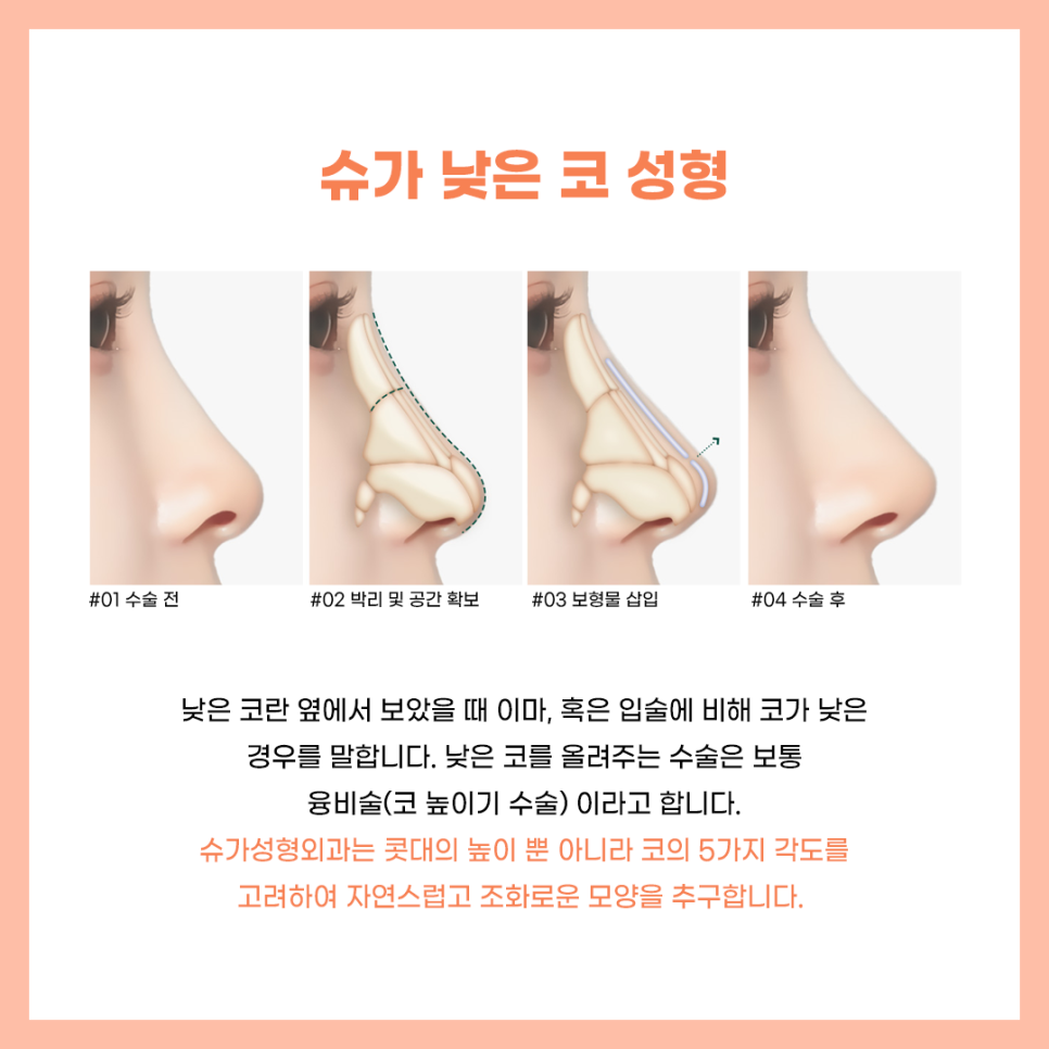 코수술잘하는곳 알아보고 있다면? 관련 이미지 3