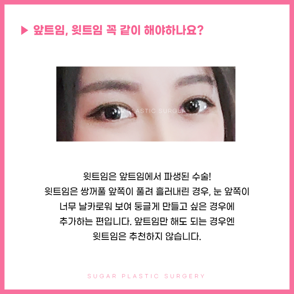 앞윗트임 어디까지 알아봤나요? 관련 이미지 3