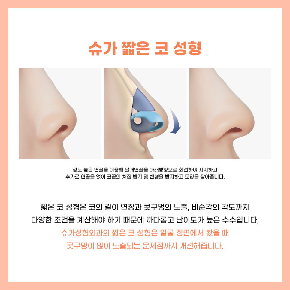 코수술잘하는곳 알아보고 있다면? 관련 이미지 5